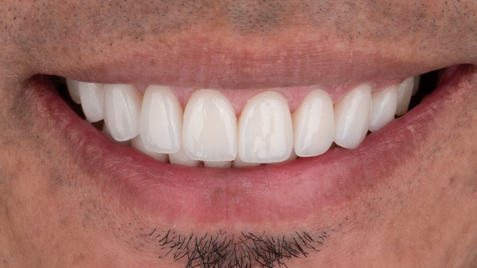 Veneers 1 — After