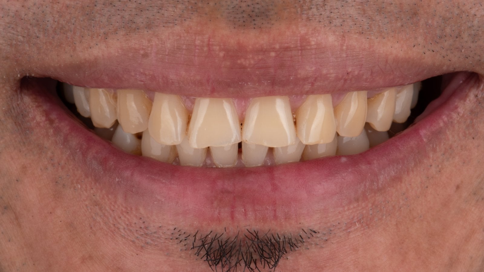 Veneers 1 — Before