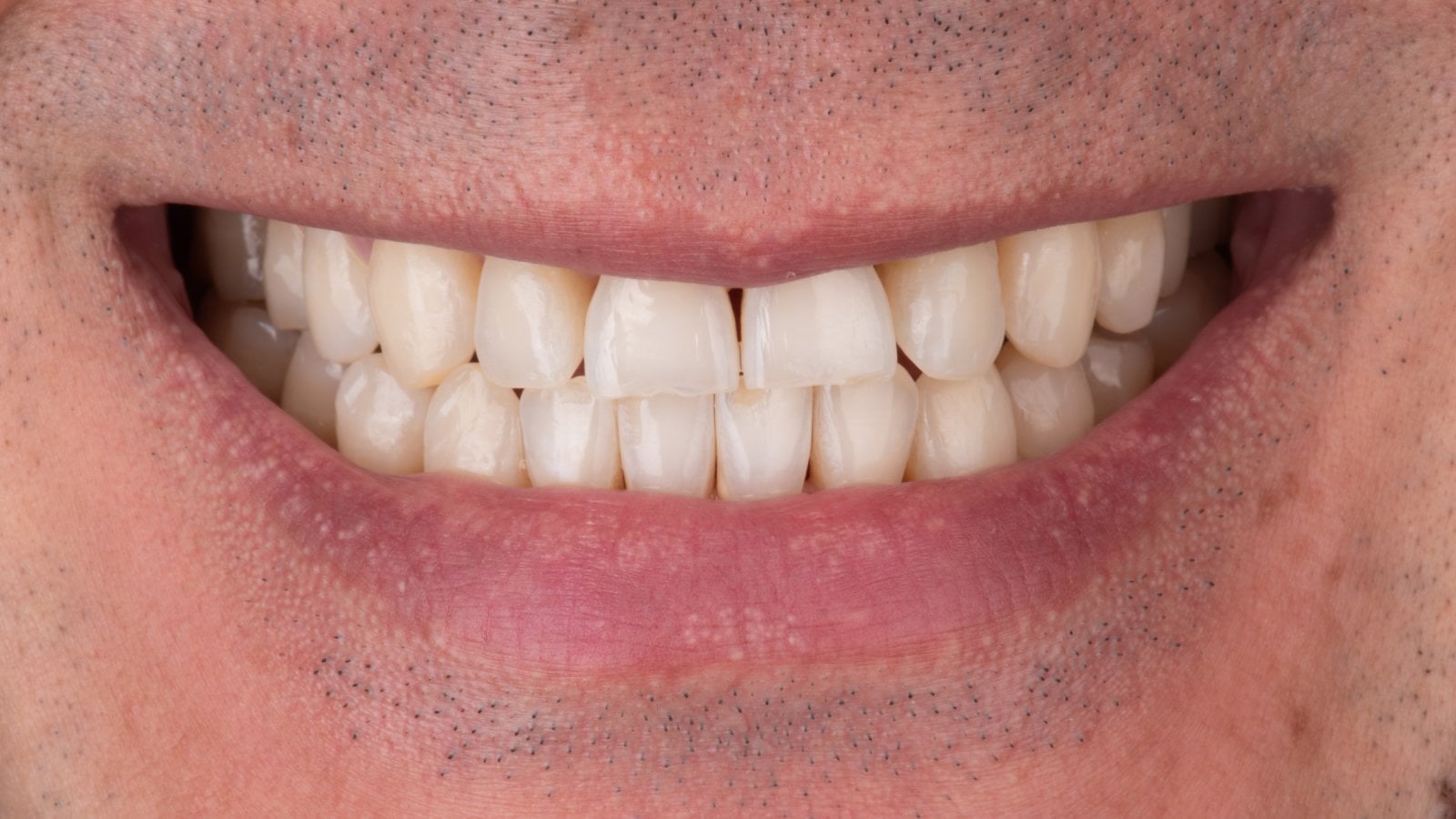 Veneers — Case 2 — Before