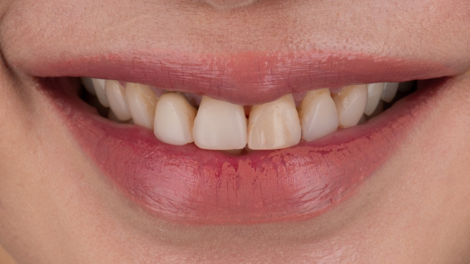 Veneers — Case 3 — Before