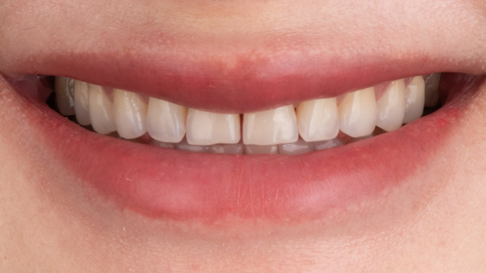Veneers — Case 4 — Before