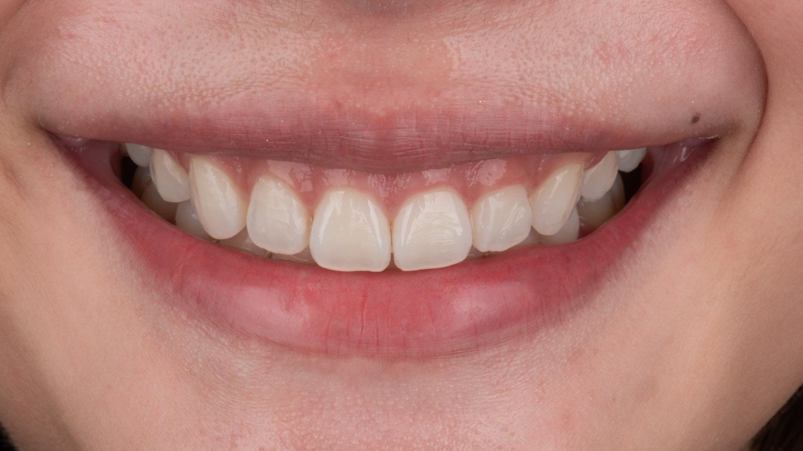 Veneers — Case 5 — Before