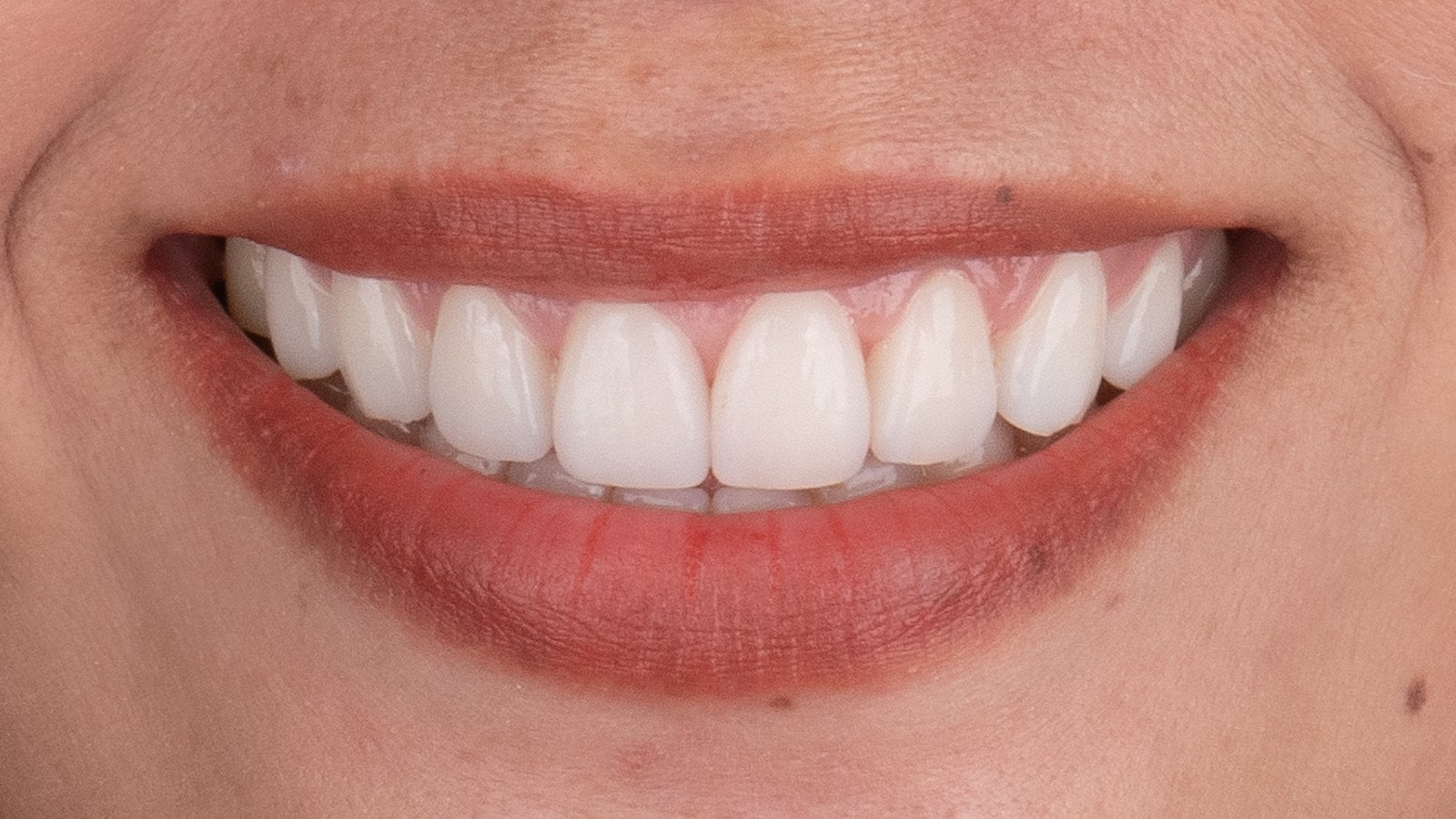 Veneers 6 — After