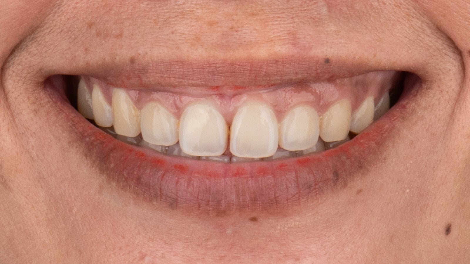 Veneers 6 — Before