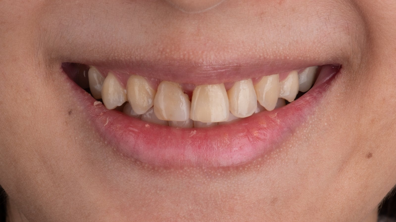 Veneers — Case 7 — Before